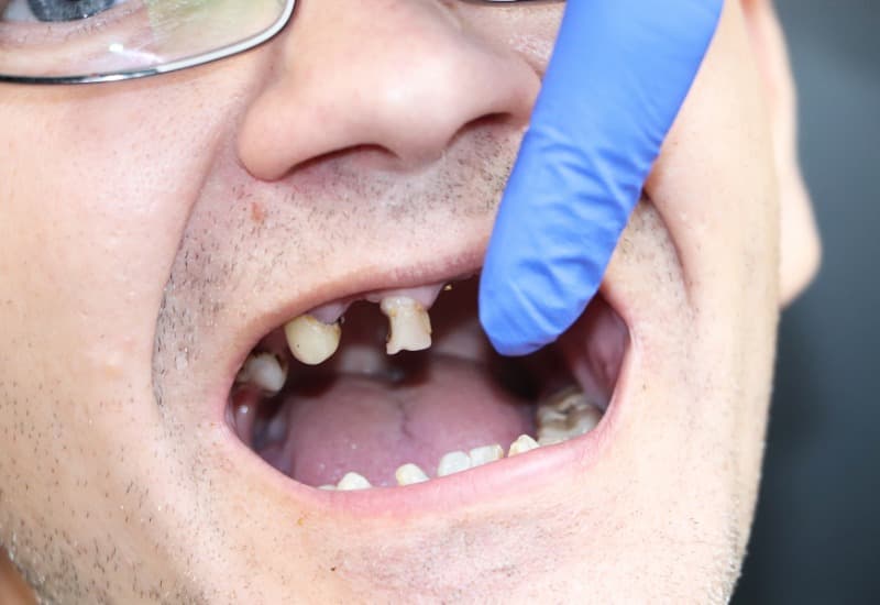 Nếu sâu răng và nhiễm trùng không được điều trị, có thể dẫn đến tình trạng cấu trúc răng bị phá hủy và cuối cùng là mất răng.