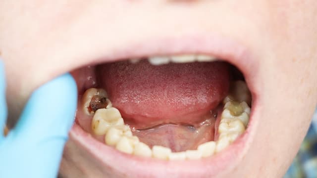 Sâu răng là gì: Khái niệm và phương pháp điều trị theo giai đoạn