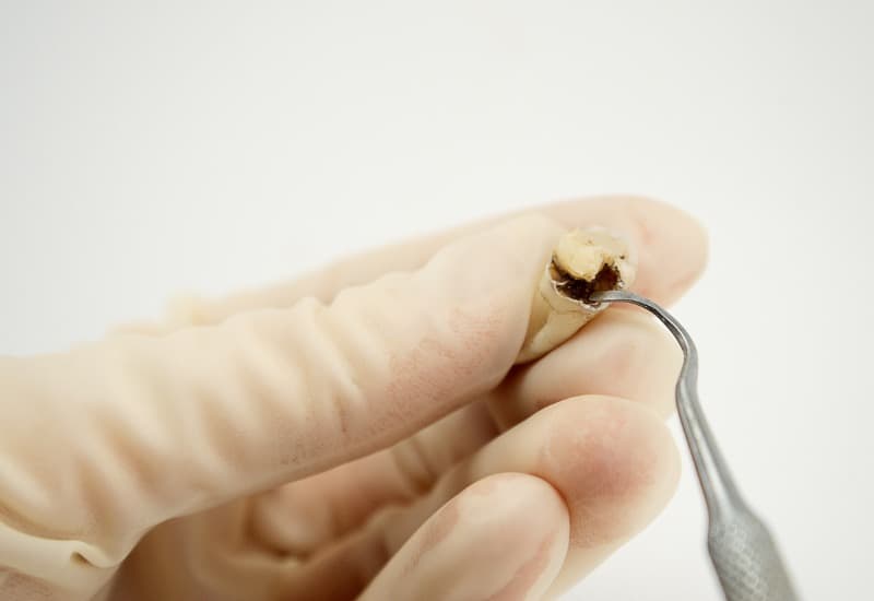 Sâu răng là một tình trạng mà trong đó, cấu trúc của răng bị phá hủy do sự tấn công của acid sản sinh từ vi khuẩn trong khoang miệng.