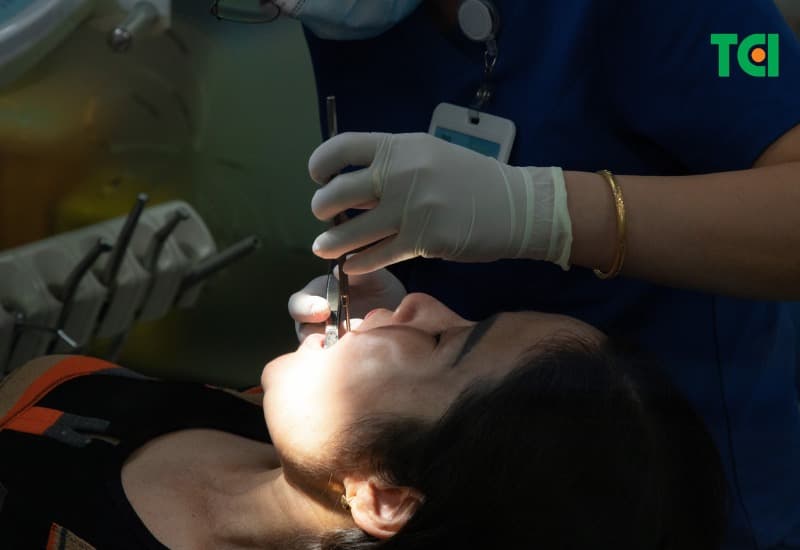 Sâu răng tiến triển vào tủy răng, có thể gây viêm tủy.