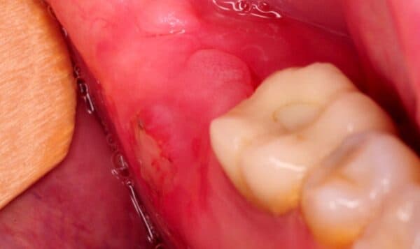 Viêm lợi có thể khiến cho nướu bị sưng lên.