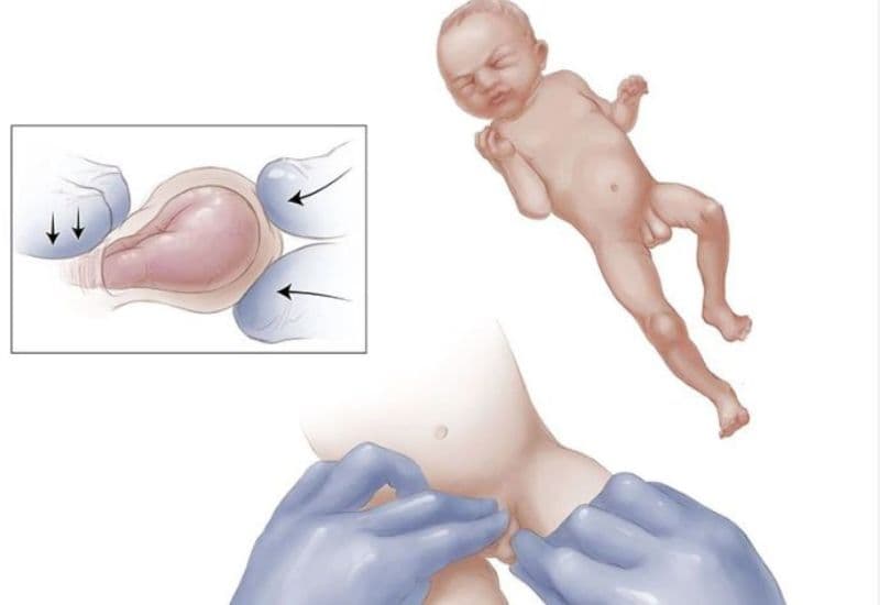 khi nào cần mổ thoát vị bẹn