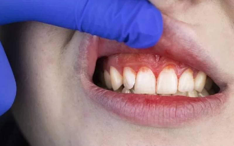 Tìm thuốc chữa viêm nướu răng