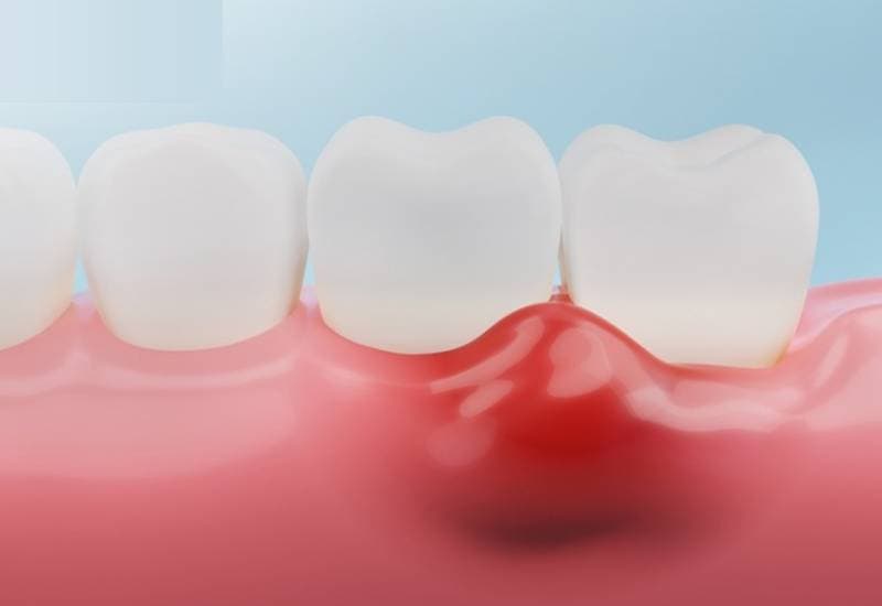 thuốc trị viêm nướu răng nào