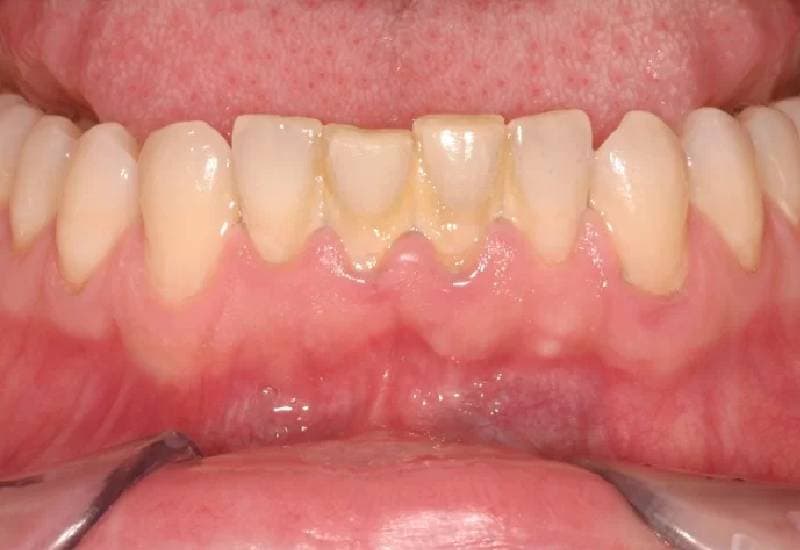 thuốc trị viêm nướu răng là gì