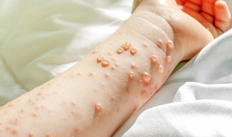 Bên trong nốt mụn chứa dịch