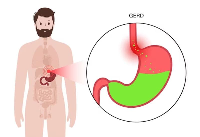 Nguyên nhân thường xuyên ợ hơi do các bệnh lý tiêu hóa