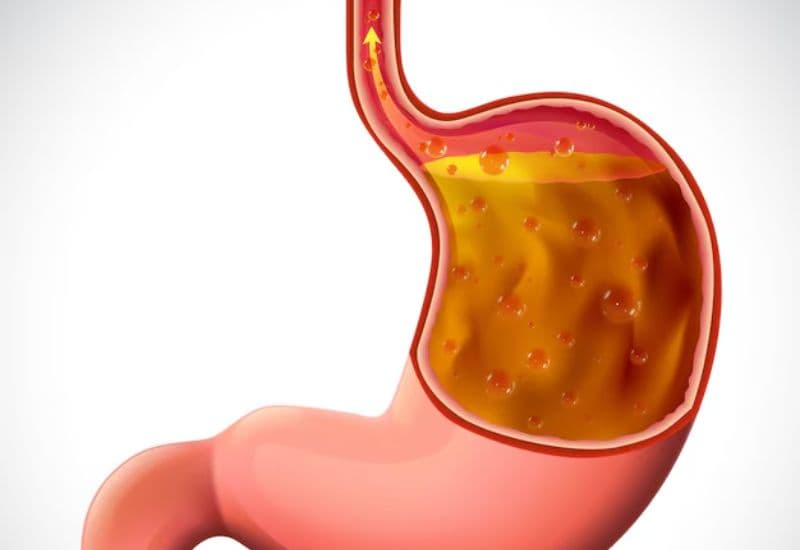 Điểm mặt các nguyên nhân gây ra tình trạng ợ nóng