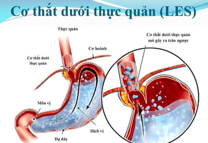 Nguyên nhân chủ yếu gây trào ngược axit dạ dày thực quản