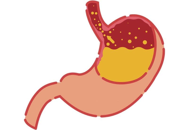 Nguyên nhân, biểu hiện trào ngược dạ dày gây hôi miệng