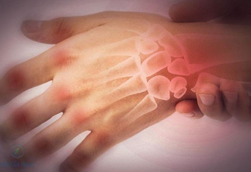 trật khớp cổ tay