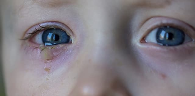 Trẻ bị đau mắt có ghèn vàng: Bệnh lý liên quan và cách xử lý