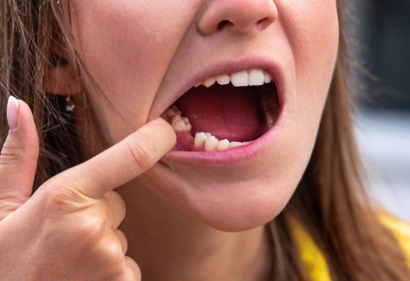 Trồng răng hàm dưới là giải pháp được thực hiện nhằm phục hồi chức năng ăn nhai và thẩm mỹ khi mất răng hàm dưới.