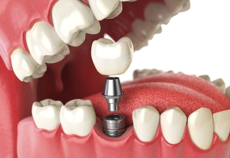 Trong phương pháp implant, một trụ implant thường làm từ titan được cấy vào xương hàm tại vị trí mất răng. 