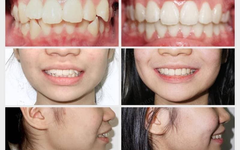 trước và sau khi niềng răng hô khác biệt
