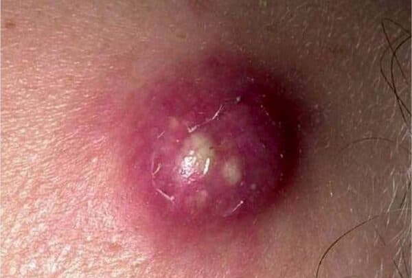 Biến chứng u bã đậu