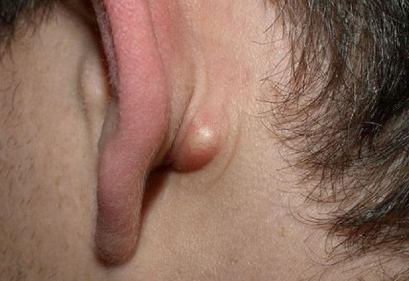 u bã đậu ở tai