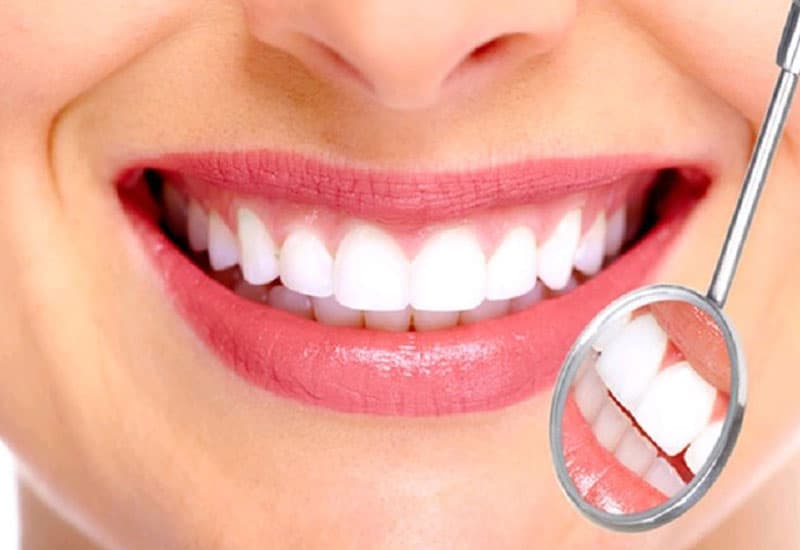 Úp răng sứ là gì