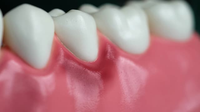 Viêm lợi là gì: Bệnh lý phổ biến nhưng không phải ai cũng hiểu