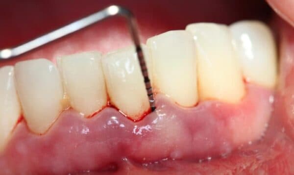 Viêm nướu răng là một bệnh lý thường thấy trong nha khoa.