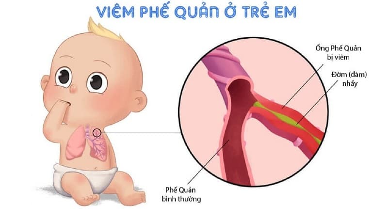 Hình ảnh ống phế quản bị viêm và ống phế quản bình thường