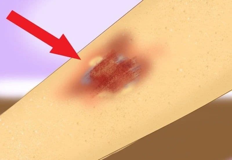 xử lý vết thương phần mềm sai cách