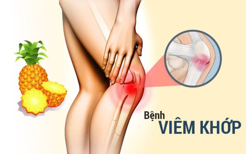 Bromelain điều trị gì