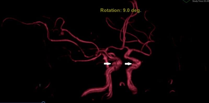 Ảnh chụp MRI chẩn đoán phình mạch não của một bệnh nhân tại Thu Cúc TCI