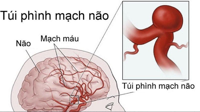 Túi phình bị vỡ sẽ gây nguy hiểm tới tính mạng người bệnh