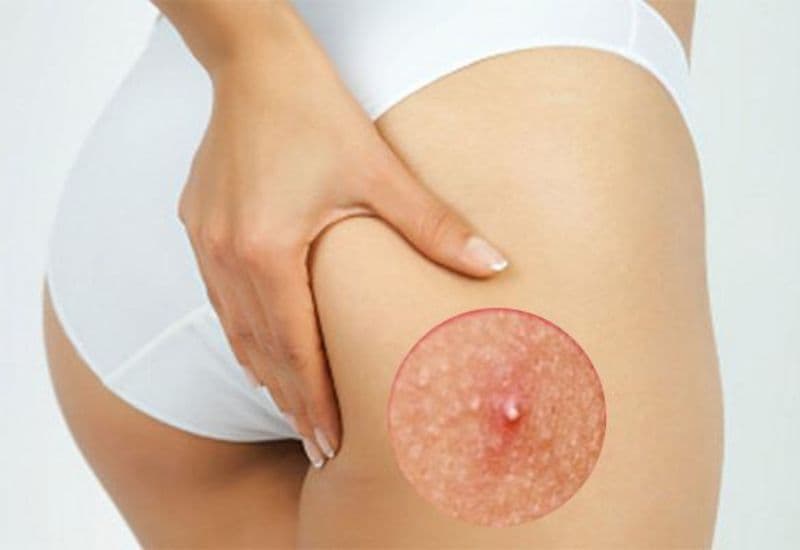 Các triệu chứng của áp xe mông thường rất rõ ràng và có thể nhận biết