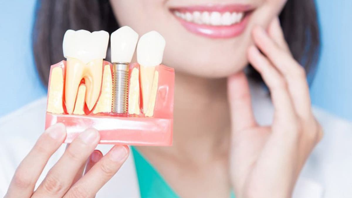 Bảng giá trồng răng Implant: Phân tích chuyên sâu và cập nhật