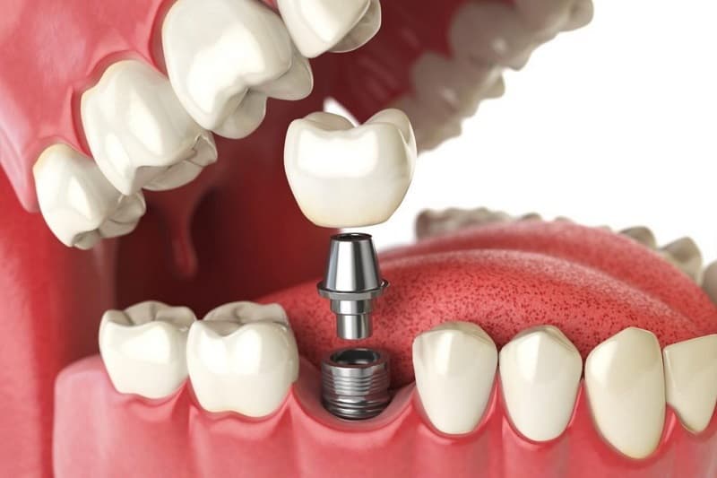 Phương pháp Implant từ lâu đã là phương án cải thiện nhiều vấn đề cho người mất răng.