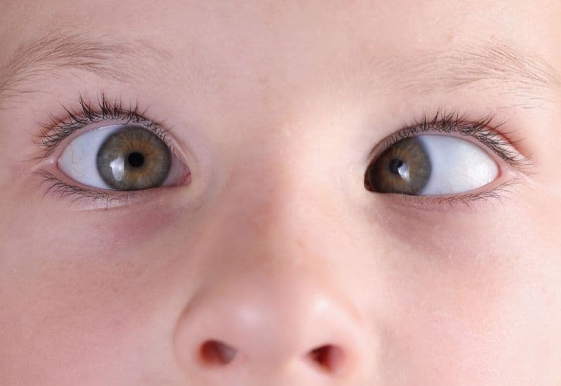 Bệnh mắt lác là tình trạng mà trong đó, hai mắt không cùng hướng về một điểm dù đang nhìn vào một vật thể.