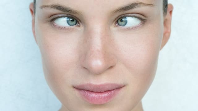 Bệnh mắt lác: Nguyên nhân và 5 phương pháp điều trị phổ biến