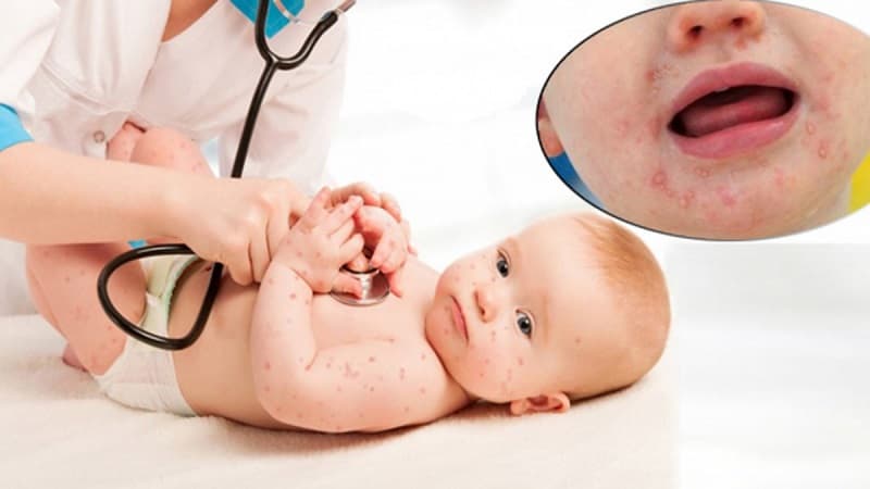 Cần đưa trẻ đến bệnh viện khi có dấu hiệu bị chân tay miệng độ 3