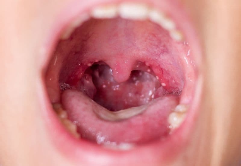 Triệu chứng nhẹ của bệnh tay chân miệng trẻ em