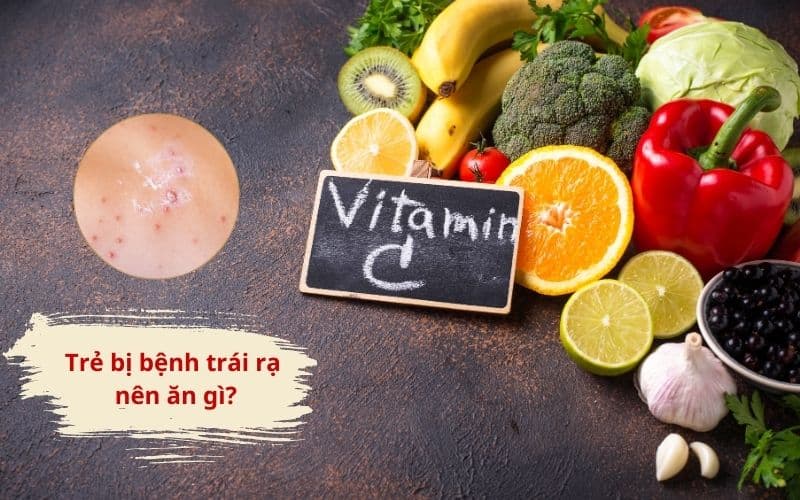 Trẻ bị bệnh trái rạ nên ăn gì? Vitamin C là một nhóm chất cần được bổ sung