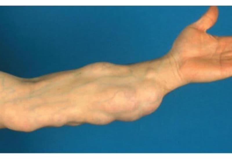 u mỡ đối xứng ở tay