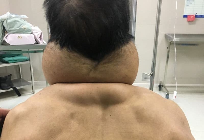 biểu hiện bệnh u mỡ đối xứng