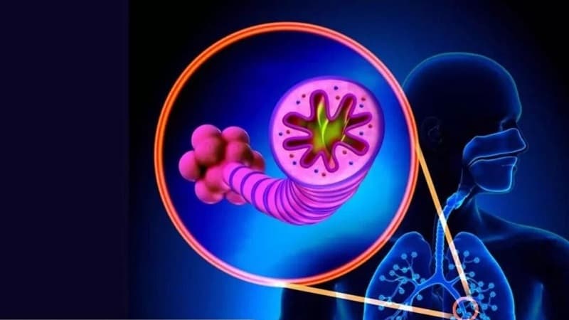 Hình ảnh minh họa tình trạng viêm phế quản cấp