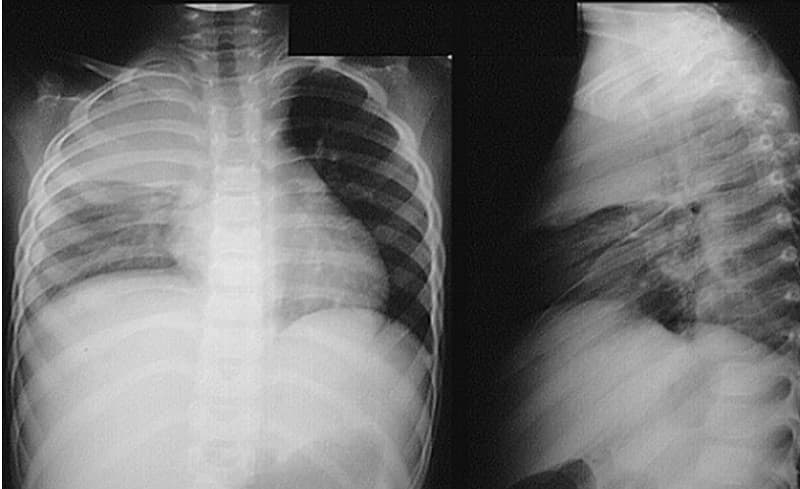 Hình ảnh X-quang phổi 