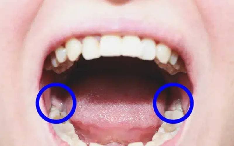 Bị sưng nướu răng trong cùng hàm dưới do đâu