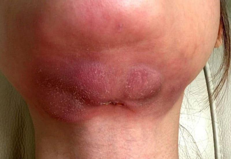 biến chứng áp xe tự vỡ