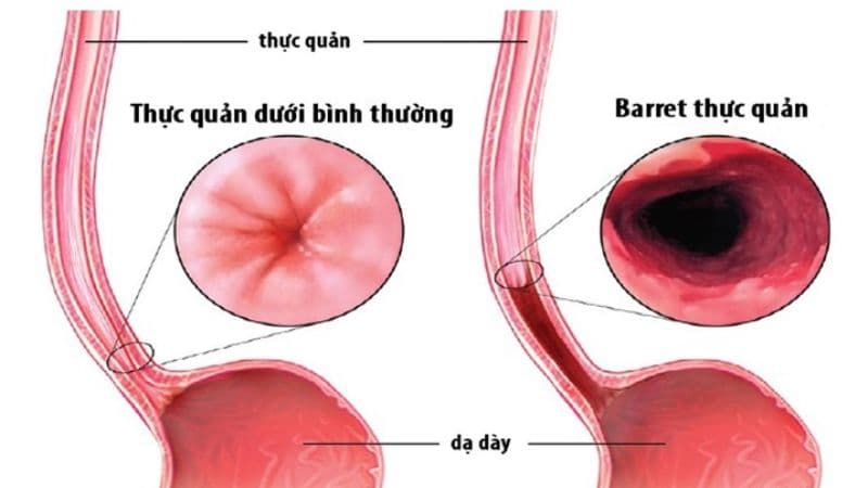 Biến chứng của trào ngược dạ dày