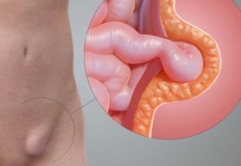 dấu hiệu thoát vị bẹn