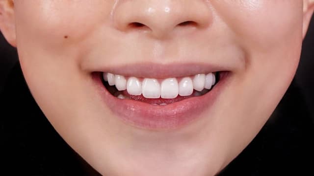 Bọc răng sứ bao nhiêu tiền &#8211; Đi tìm lời giải đáp