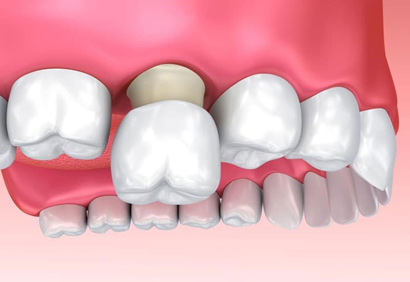 Bọc răng sứ hàm trên có đắt không 
