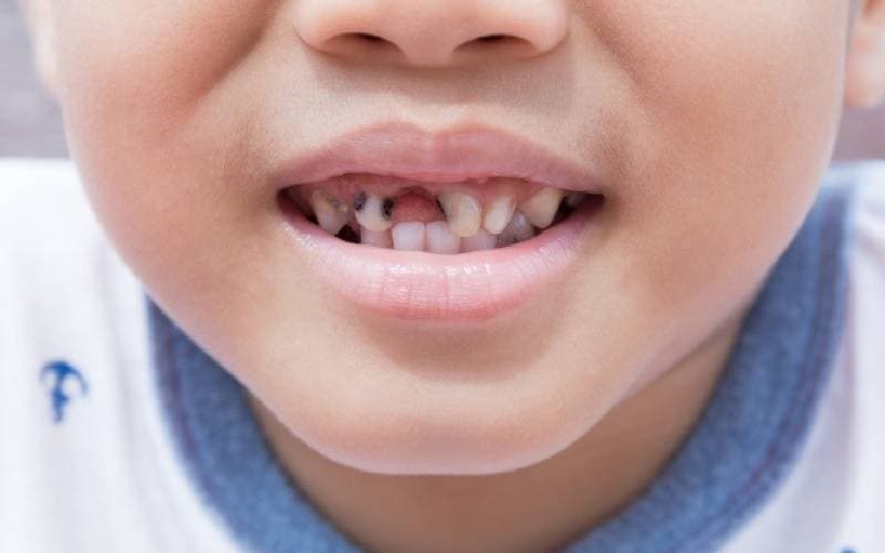 hướng dẫn cách trị sâu răng cửa