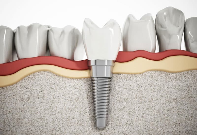 Cấy ghép răng Implant bao nhiêu tiền thế