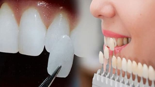 Chi phí dán sứ veneer và những thông tin bên lề